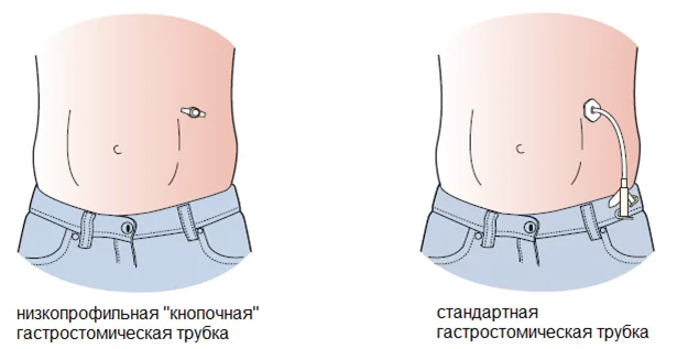 Приложение А3. Справочные материалы — Недостаточность питания у детей старше 1 года (Белково-энергетическая недостаточность)