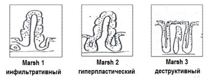 1.5 Классификация заболевания или состояния — Целиакия