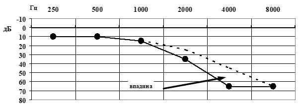 1.6 Клиническая картина заболевания или состояния — Потеря слуха, вызванная шумом