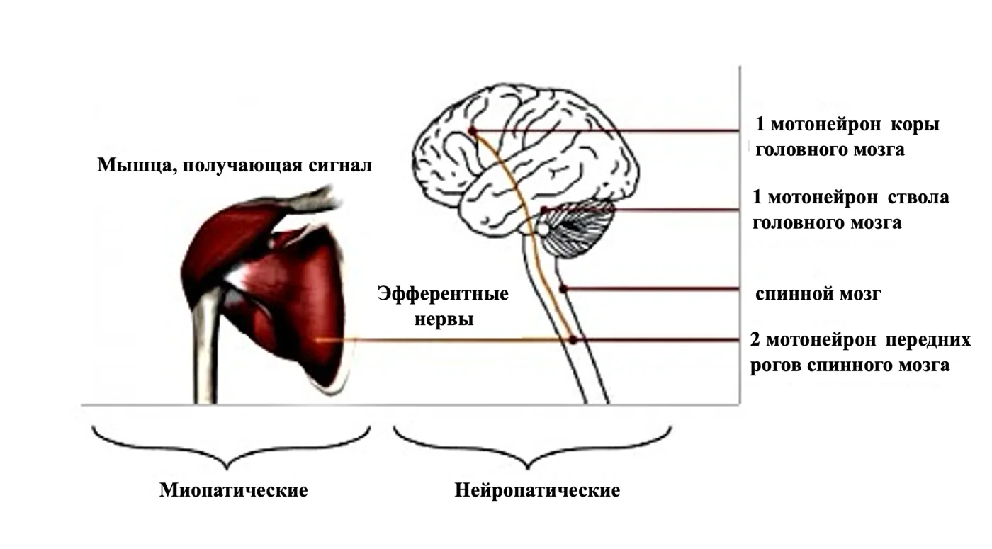 1.2 Этиология и патогенез заболевания или состояния (группы заболеваний или состояний) — Нервно-мышечный сколиоз