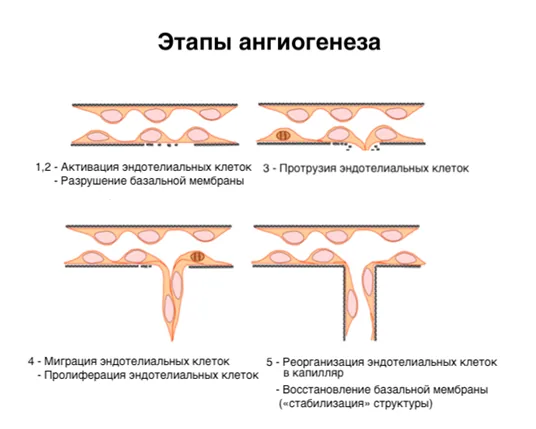 1.2 Этиология и патогенез заболевания или состояния (группы заболеваний или состояний) — Гемангиома инфантильная