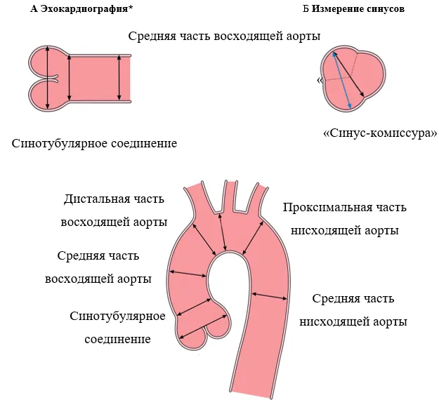 2.4 Инструментальные исследования — Аневризмы грудной и торакоабдоминальной аорты
