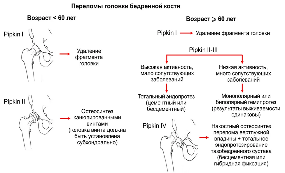 Приложение Б. Алгоритмы действий врача — Переломы проксимального отдела бедренной кости