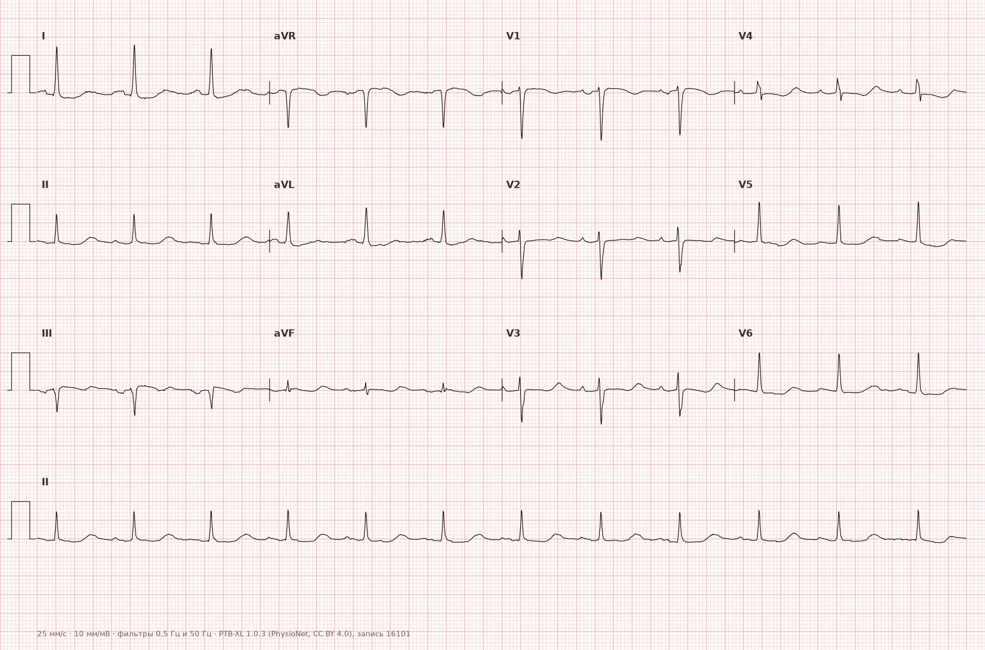 Электролитные нарушения на ЭКГ на ЭКГ — пример 1, 12 отведений