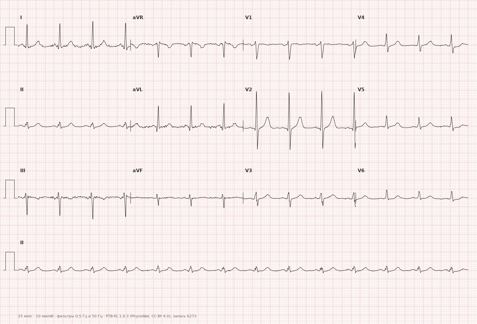 Широкий комплекс QRS на ЭКГ — пример 1, 12 отведений