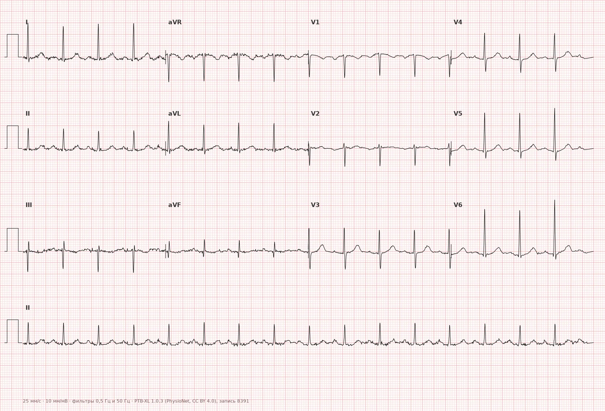 Высокий вольтаж QRS на ЭКГ — пример 1, 12 отведений